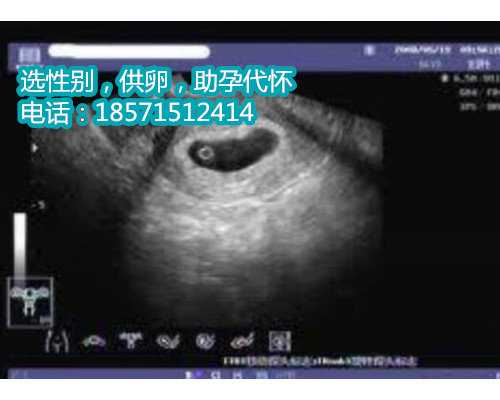 南京助孕代母脐动脉血流S/D的正常值范围是多少